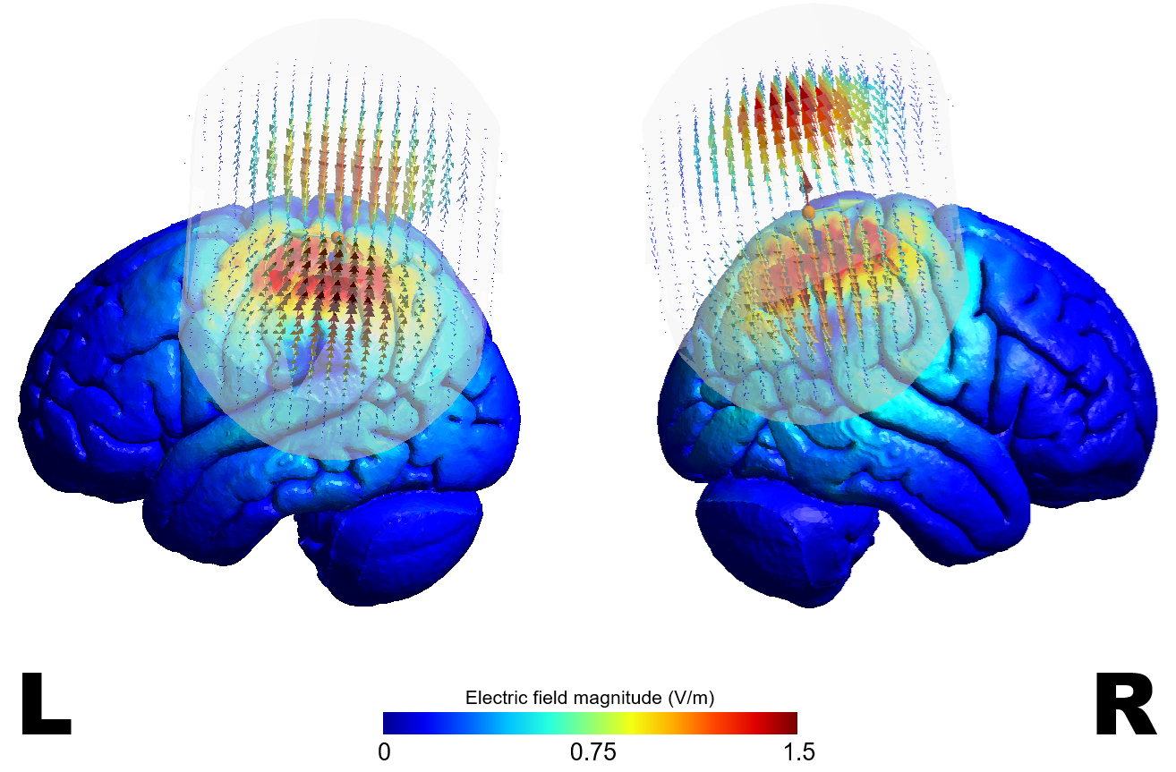 SimNIBS simulation of theta-burst stimulation at the lateral parietal cortex