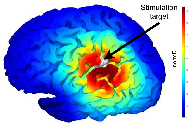 SimNIBS simulation of theta-burst stimulation at the lateral parietal cortex